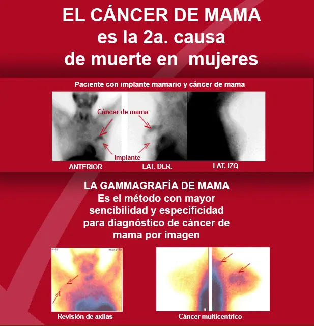 Gammagrafía de mama