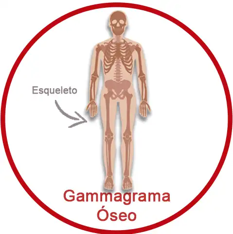 Gammagrama Óseo