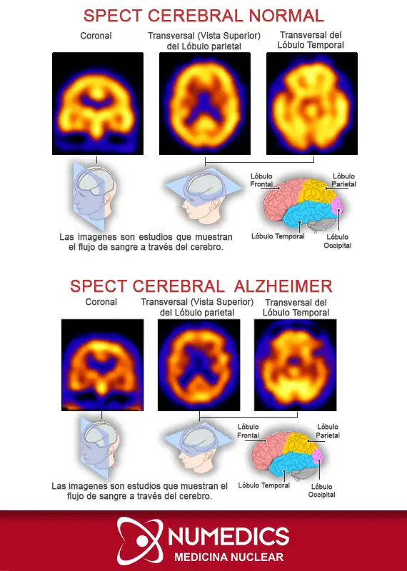 Gammagrama de perfusión cerebral