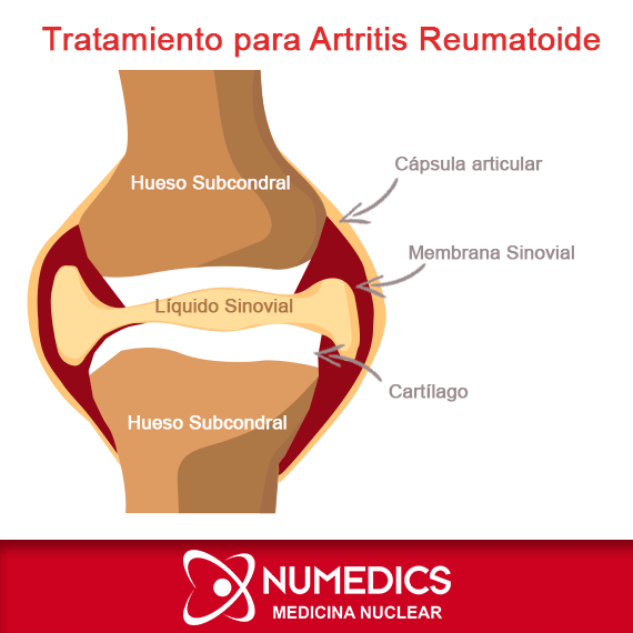 Tratamiento para artritis (Radiosinoviortesis)